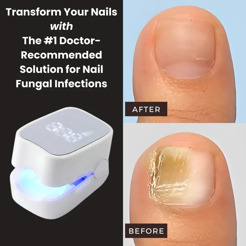 ClearNail Pro™ - Nail Fungus Laser Device